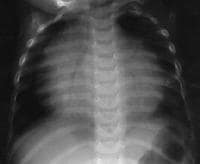 Pediatric Infective Pericarditis Workup