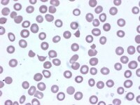 A blood smear showing a few schistocytes. This pat