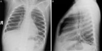 Imaging in Pediatric Pneumonia