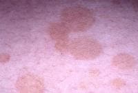 Pediatric Tinea Versicolor Clinical Presentation