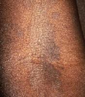 Pediatric Tinea Versicolor Clinical Presentation