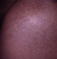 Pediatric Tinea Versicolor Clinical Presentation