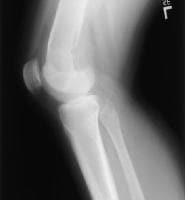 Pediatric Osteosarcoma Workup