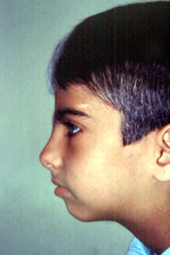 Синдром ваарденбурга фото у детей