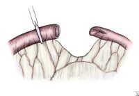 Small Intestinal Atresia and Stenosis Treatment & Management