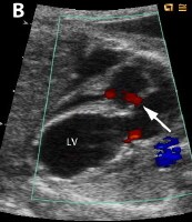 Fetal Surgery for Congenital Heart Disease