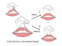 Unilateral Cleft Lip Repair Treatment & Management: Surgical Therapy ...