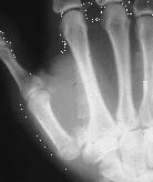 Thumb Fractures and Dislocations: Background, History of the Procedure ...