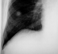 Solitary Pulmonary Nodule