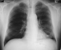 Solitary Pulmonary Nodule