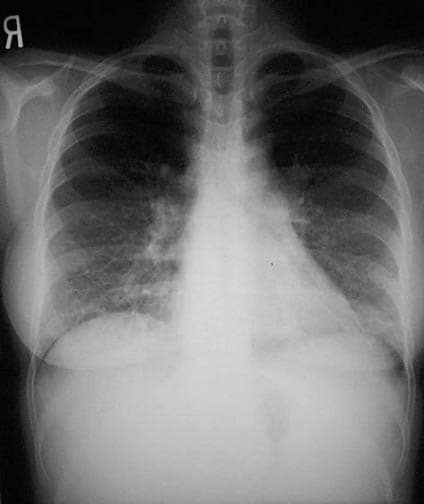 Parenchymal Scarring