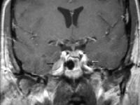 Imaging in Cranial Nerve Schwannoma