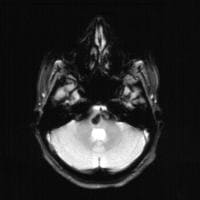 Brain Imaging in Cavernous Angiomas