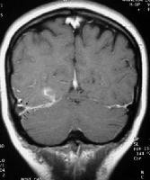 Brain Imaging in Venous Sinus Thrombosis: Overview, Computed Tomography ...