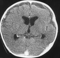 Subdural effusion; Cerebrospinal Fluid Effusion, Subdural; Hygroma ...