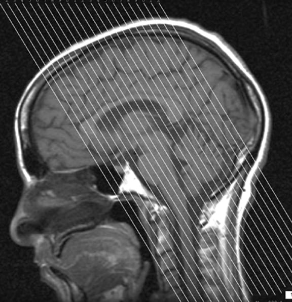 Technology and Techniques in Radiology: Hippocampus MRI