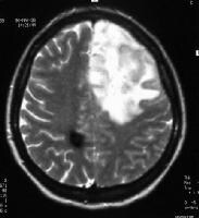 Imaging in Oligodendroglioma