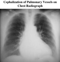 Imaging in Dilated Cardiomyopathy