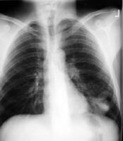 Imaging in Thoracic Blastomycosis