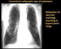 Emphysema Imaging: Overview, Radiography, Computed Tomography