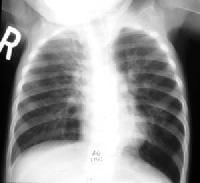 Swyer-James Syndrome Imaging