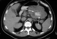 Imaging in Gastrointestinal Stromal Tumors - Leiomyoma/Leiomyosarcoma ...