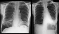 Pneumoperitoneum Imaging: Overview, Radiography, Computed Tomography