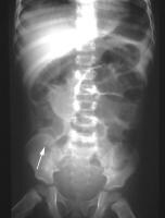 Small-Bowel Obstruction Imaging: Overview, Radiography, Computed Tomography