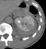 Imaging in Kidney Trauma: Overview, Radiography, Computed Tomography