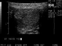 Malignant Testicular Tumor Imaging