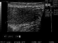 Malignant Testicular Tumor Imaging