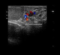 Varicocele Imaging