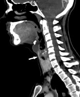 Thyroglossal Duct Cyst Imaging: Overview, Computed Tomography, Magnetic ...