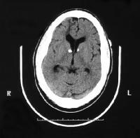 Tuberous Sclerosis Imaging