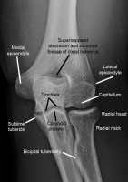 Imaging of Elbow Fractures and Dislocations in Adults: Overview ...