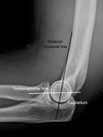 Imaging of Elbow Fractures and Dislocations in Adults: Overview ...