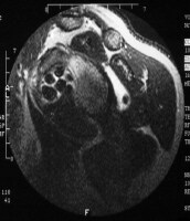 Synovial Osteochondromatosis: Overview, Radiography, Computed Tomography