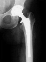 Hip Replacement Imaging