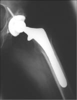 Hip Replacement Imaging