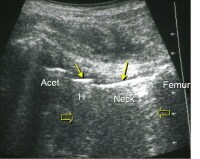 Hip Replacement Imaging