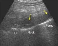 Hip Replacement Imaging