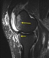 Hyperextension anterior 