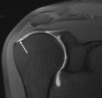 Rotator Cuff Injury MRI: Overview, Magnetic Resonance Imaging