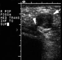 Baker Cyst Imaging: Overview, Radiography, Computed Tomography