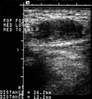 Baker Cyst Imaging: Overview, Radiography, Computed Tomography