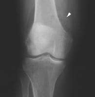 Baker Cyst Imaging: Overview, Radiography, Computed Tomography