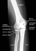 Imaging of Elbow Fractures and Dislocations in Adults: Overview ...