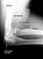 Imaging of Elbow Fractures and Dislocations in Adults: Overview ...