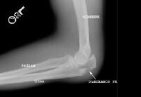 Imaging of Elbow Fractures and Dislocations in Adults: Overview ...