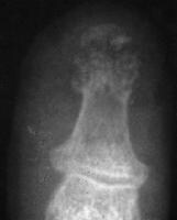 Finger and Thumb Trauma Imaging: Overview, Radiography, Computed Tomography